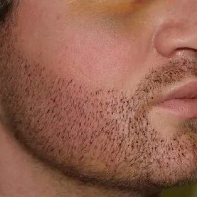 Best Beard Hair Transplant Cost In Dubai Price