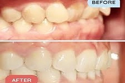 Fix-Overlapping-Teeth-without-Braces-in-Abu-Dhab