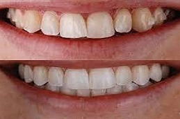 Fix-Overlapping-Teeth-without-Braces