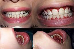 Teeth-polishing-Scaling-Treatment (2)