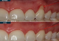 علاج تراجع اللثة في دبي وأبو ظبي والشارقة والعين