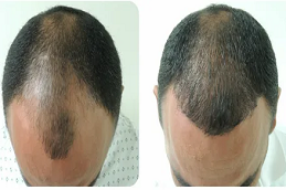 زراعة الشعر في ابوظبي