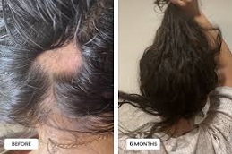 أفضل أخصائي علاج الشعر في دبي وأبو ظبي والشارقة والعين