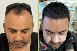 زراعة الشعر بالروبوت في دبي وأبوظبي والشارقة والعين