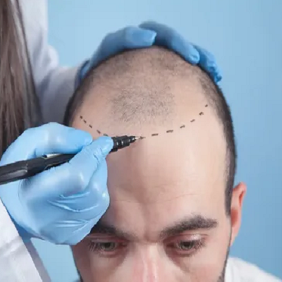 hair transplant in Dubai