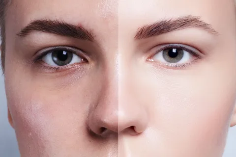 HydraFacial Before and After