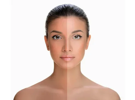 Fotona 4d Lip Augmentation before and after