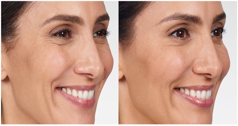 Botox before and after