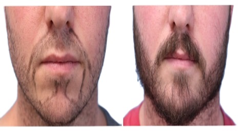 Beard hair transplant before and after