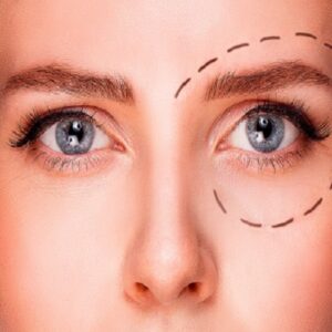 Blepharoplasty Cost in Dubai