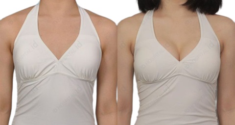 Breast Surgery before and after