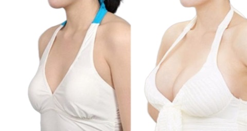 Breast Surgery before and after