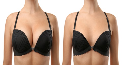 Breast Surgery before and after