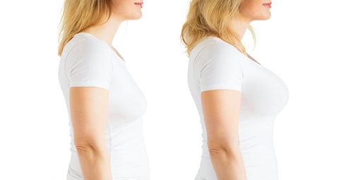 Breast Surgery before and after