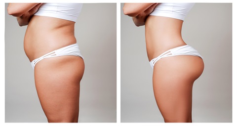 Buttock augmentation before and after