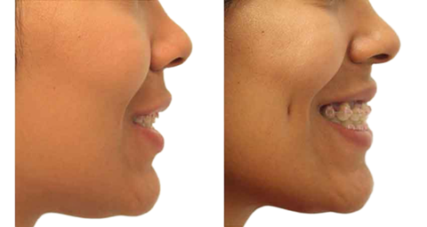 Dimple creation before and after