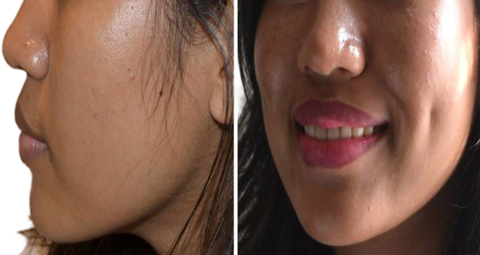 Dimple creation before and after