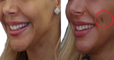Dimple creation before and after