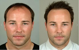 Hair transplant before and after