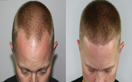 Hair transplant before and after