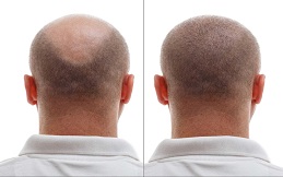 Hair transplant before and after