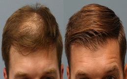 Hair transplant before and after