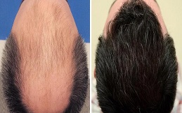 Hair transplant before and after