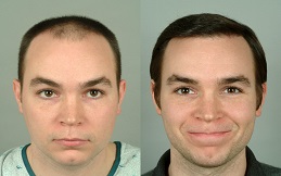 Hair transplant before and after