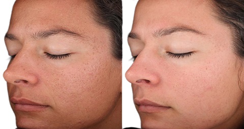 HydraFacial Before and After
