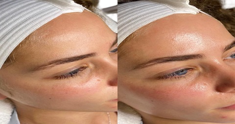 HydraFacial Before and After