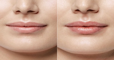 Lip Fillers Before and After