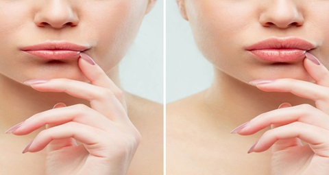 Lip Fillers Before and After