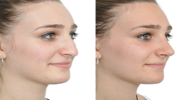 Rhinoplasty before and after