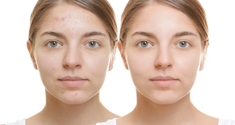 Skin Whitening before and after