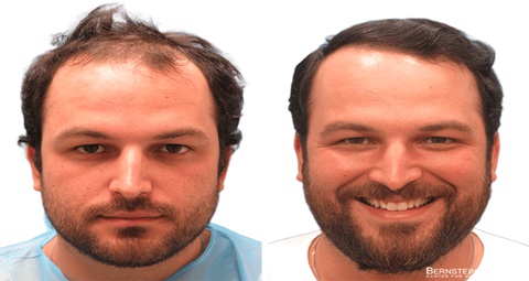 Beard hair transplant before and after
