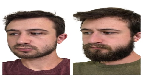 Beard hair transplant before and after