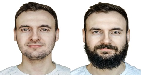 Beard hair transplant before and after