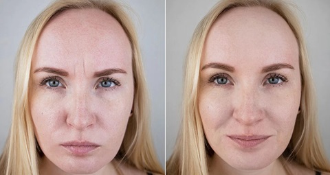 Botox before and after