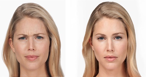 Botox before and after