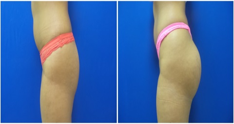 Buttock augmentation before and after