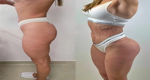 Buttock augmentation before and after