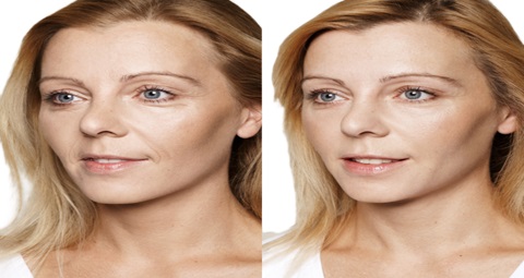 Cosmetic injections before and after
