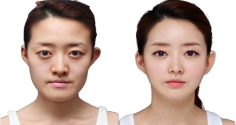 Cosmetic surgery before and after