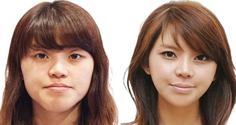Cosmetic surgery before and after