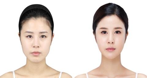 Cosmetic surgery before and after