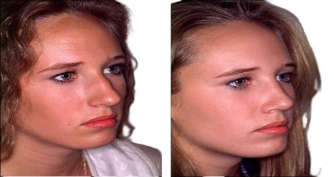 Cosmetic surgery before and after