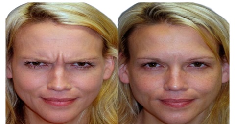 Cosmetic injections before and after