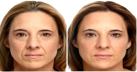 Cosmetic injections before and after
