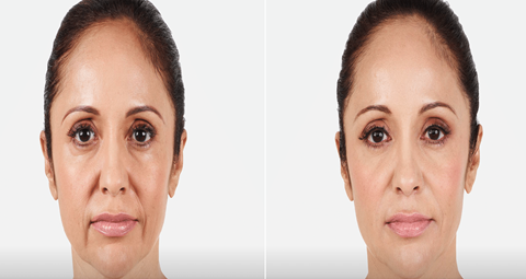 Dermal filler before and after