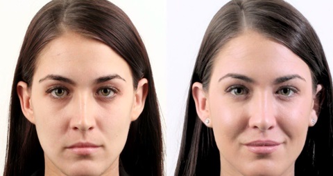 Dermal filler before and after